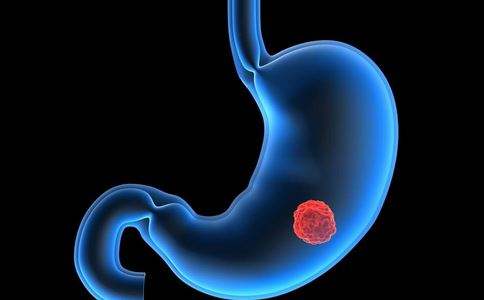胃病与胃癌有什么关系？哪些胃病可能癌变?